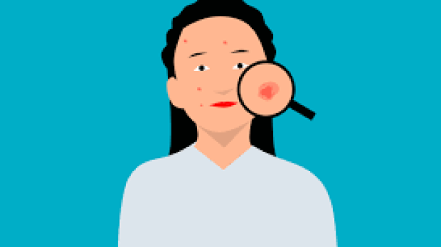 Cara Menghilangkan Jerawat dengan Cepat dalam 1 Hari